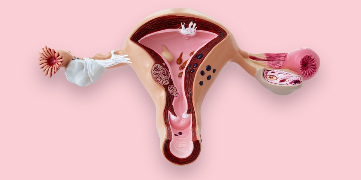 sop-sindrome-ovario-poliquistico